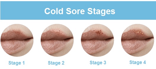 [DIAGRAM] Diagram Of Cold Sore - MYDIAGRAM.ONLINE